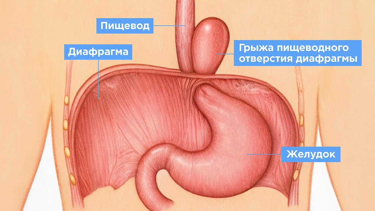 Диафрагмальная грыжа - симптомы, причины, диагностика и методы лечения